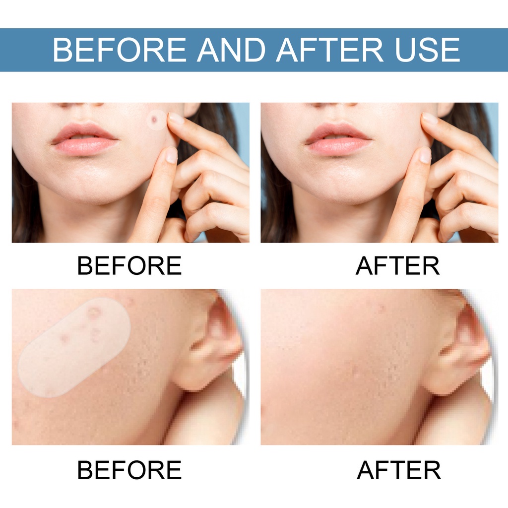 Set 80 Miếng Dán Hỗ trợ giảm mụn Vô Hình Đa Kích Thước Chăm Sóc Da Mặt
