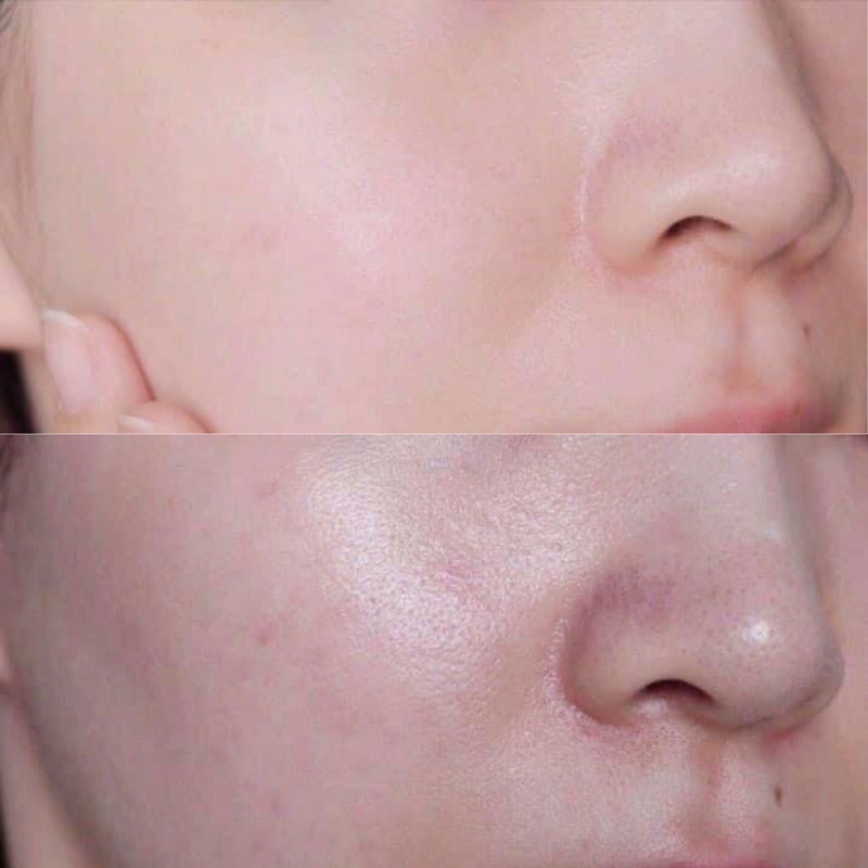 KEM LAROCHE POSAY K+ -Làm giảm LỖ CHÂN LÔNG TO, MỤN ĐẦU ĐEN | BigBuy360 - bigbuy360.vn