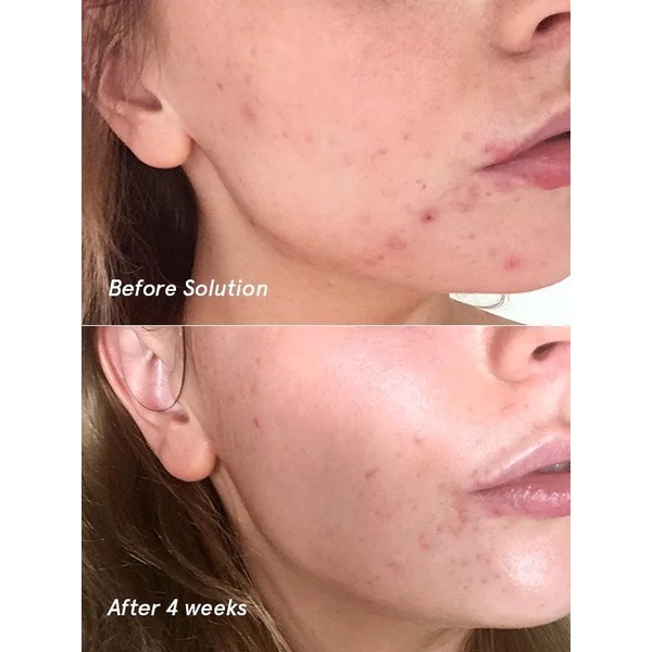 GLOSSIER Solution Toner - Toner tẩy tế bào chết hóa học AHA/BHA/PHA