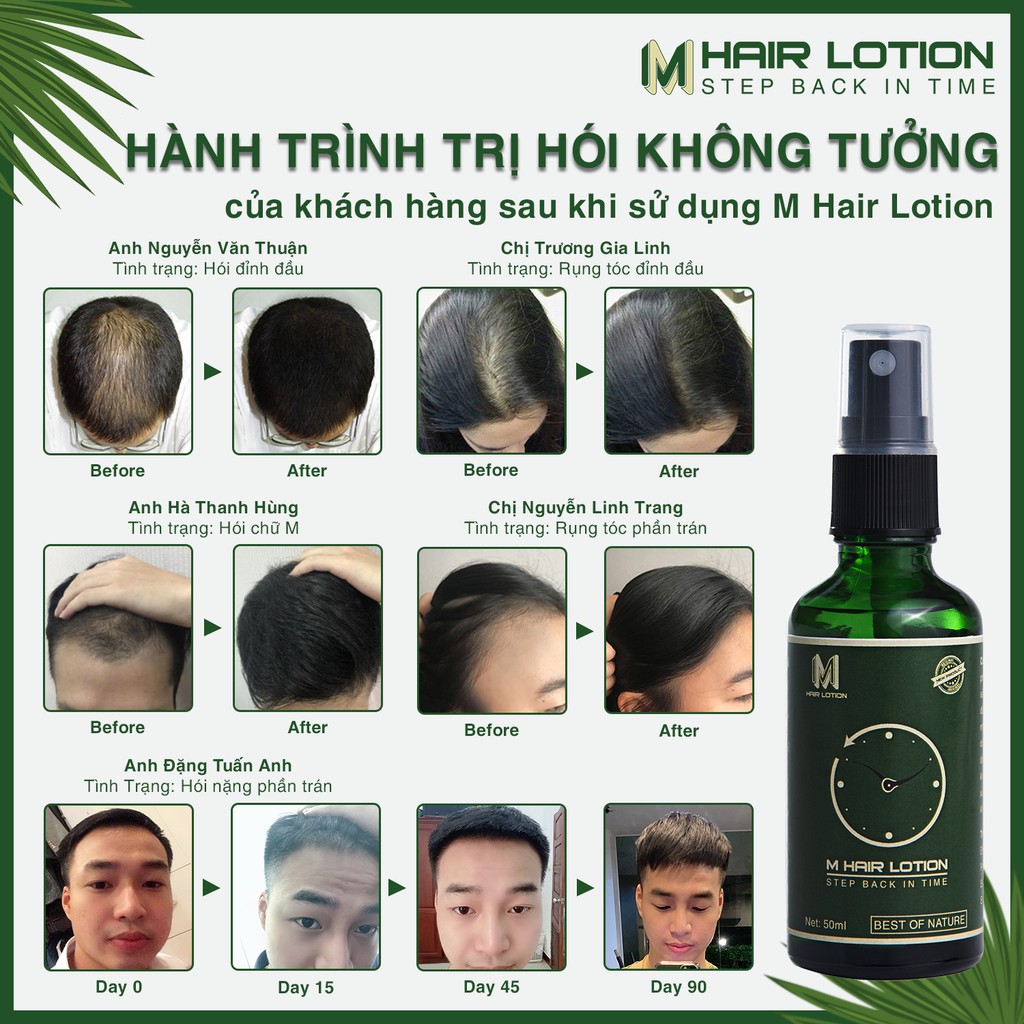 Tinh Dầu Mọc Tóc Nhanh M Hair Lotion 50ml | Ngăn Rụng Tóc | Không Dùng Với Tinh Dầu Bưởi Mọc Tóc Để Có Hiệu Quả Tốt Nhất | BigBuy360 - bigbuy360.vn