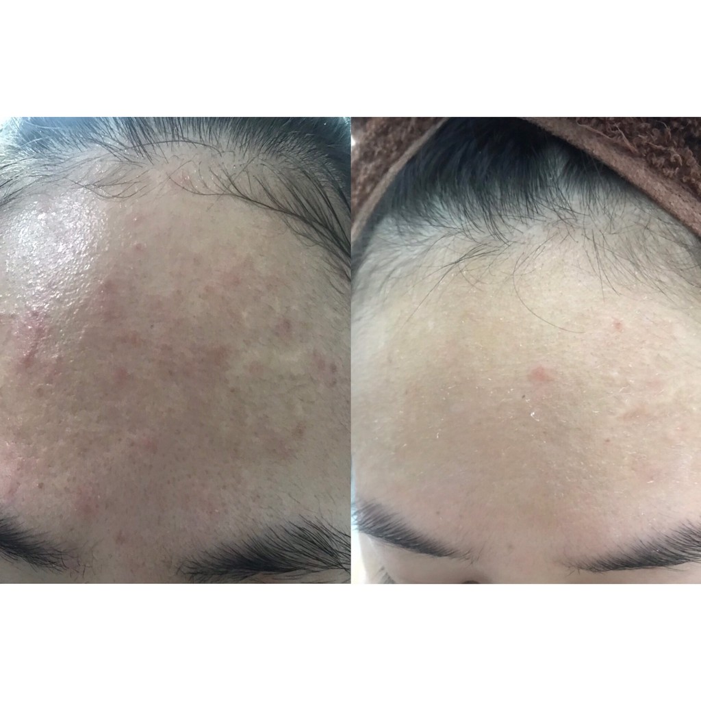 RETACNYL CREAM ( Tretinoin0,025% , 0,05%) 30gr Giảm Mụn Đầu Đen, Mụn Trứng Cá.