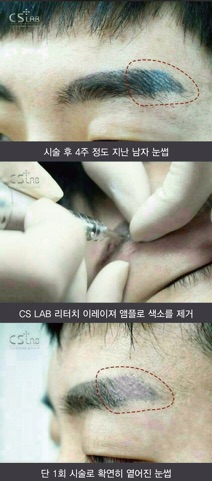 Xoá xăm CS Lab  / dcpxtrangphamsg