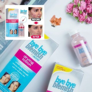 Lotion Chấm Mụn Bye-Bye Blemish For Acne