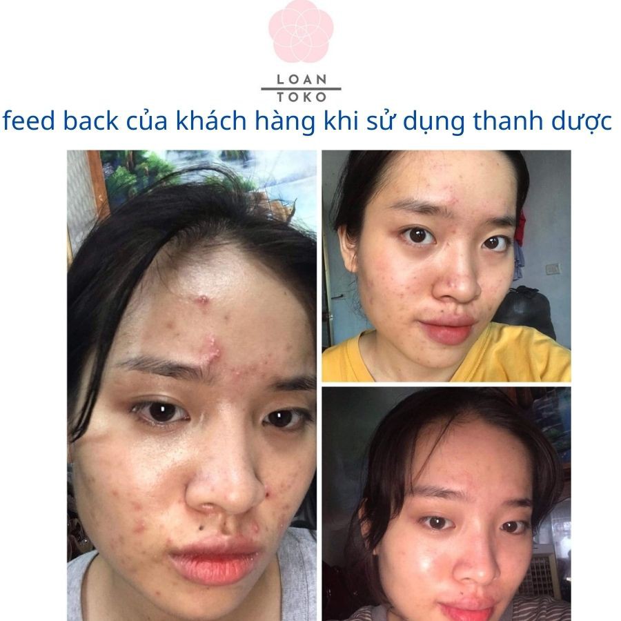 Thanh dược Skincare cho da mụn ,rỗ,nám, tàn nhang,tái tạo mờ thâm da chiết xuất từ thiên nhiên 80ml | BigBuy360 - bigbuy360.vn