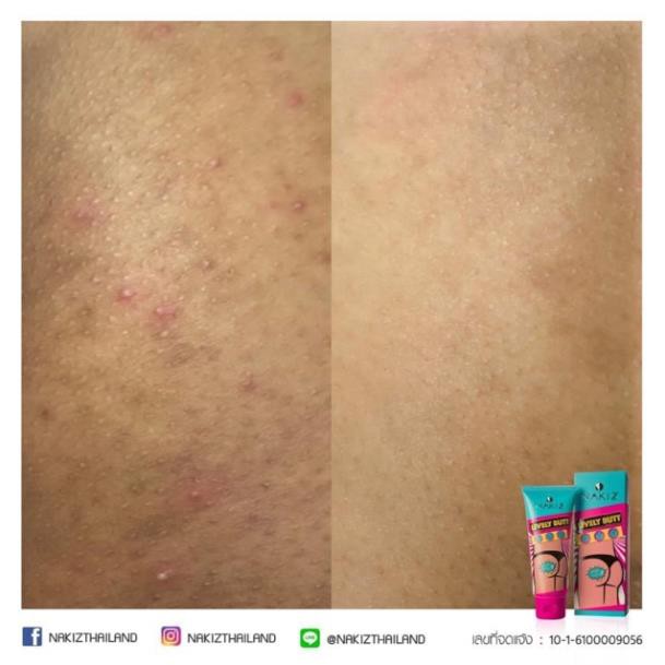 3 TUÝP NAKIZ LIVELY BUTT 〡 Kem thoa thâm Mông, Bẹn, Nách, Lưng, Nhũ hoa, Đầu gối, Cùi chỏ.... Thái Lan | BigBuy360 - bigbuy360.vn