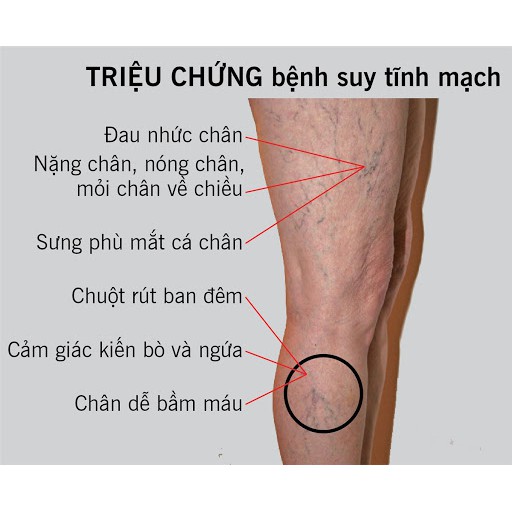 Kem Trị Suy Giãn Tĩnh Mạch PHILOSOFT Thái Lan