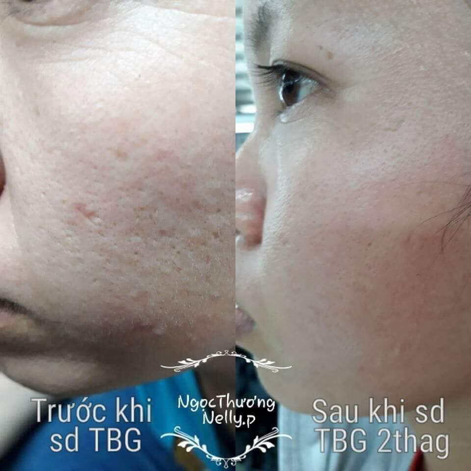 [𝐂𝐨𝐦𝐛𝐨 𝟑 𝐡𝐨̣̂𝐩]Tế bào gốc NellyP -Tinh Chất Serum Hỗ Trợ Giảm Sẹo Lồi - Sẹo Lõm - Sẹo Rỗ Lâu Năm