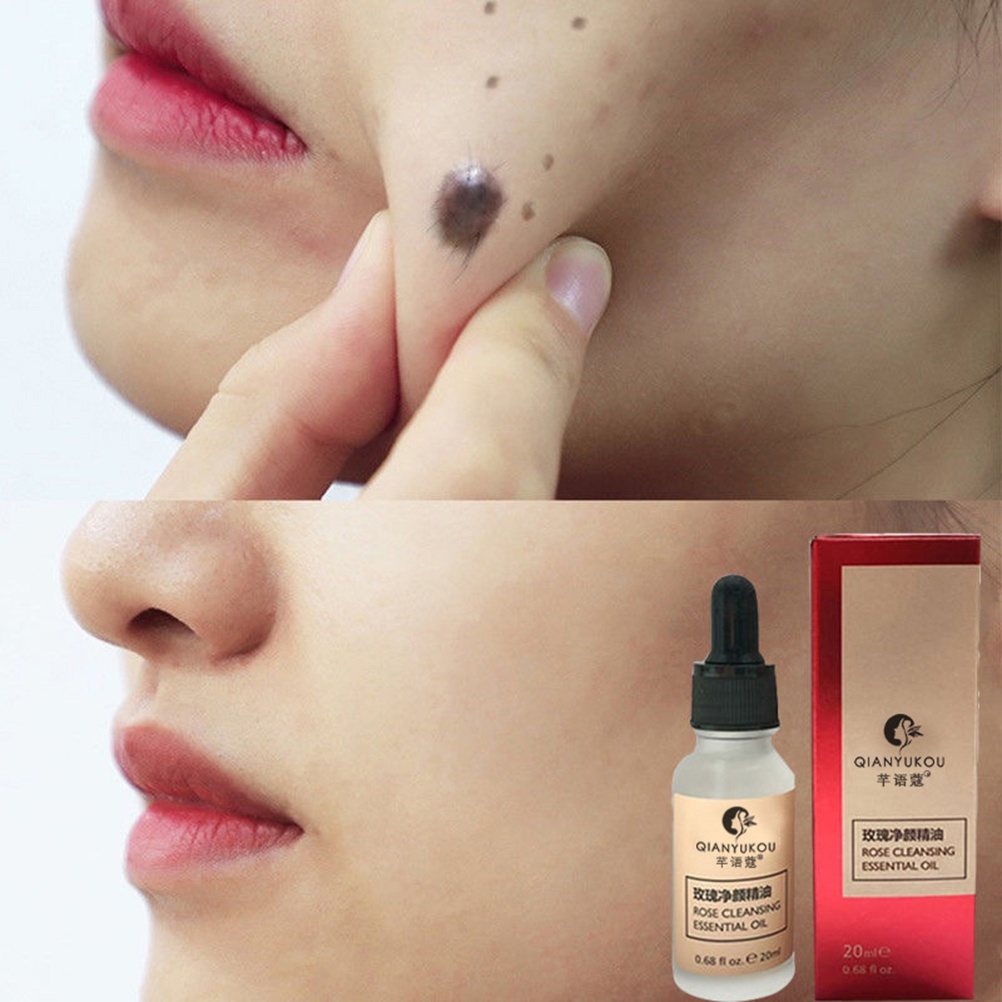 Dung dịch loại bỏ Mole hiệu quả cho da mặt 20ml | BigBuy360 - bigbuy360.vn