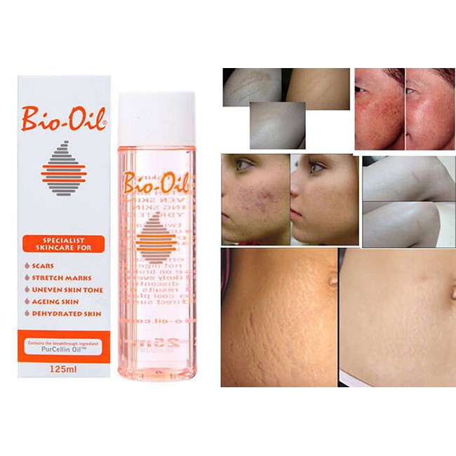 [ĐI AIR] TINH DẦU GIÚP MỜ SẸO GIẢM RẠN DA THÂM NÁM BIO OIL ÚC 60ML/125ML