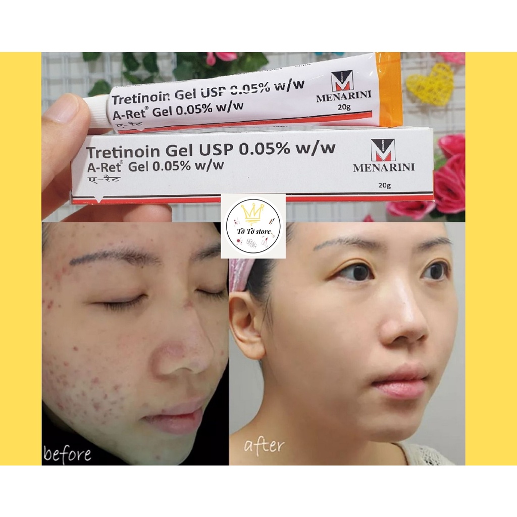 Tretinoin Aret 0.1%, 0.05%, 0.025%, Gel hỗ trợ giảm mụn [CÓ ẢNH THẬT]