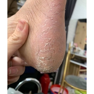 Ủ chà gót chân
