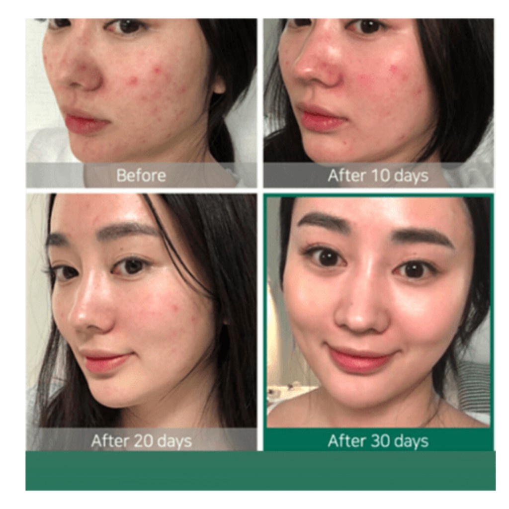 Tẩy da chết hóa học chuyên sâu The Ordinary AHA 30% + BHA 2% Peeling solution - 30ml - Skin.authentic | BigBuy360 - bigbuy360.vn