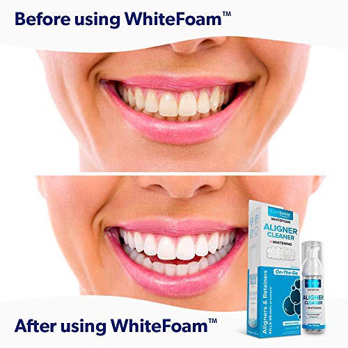 WhiteFoam làm sạch máng chỉnh nha trong suốt như Invisalign