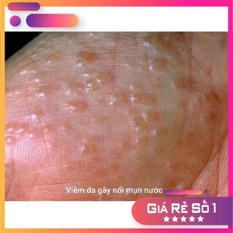 Kem bôi da kem bôi tổ đỉa ghẻ nước nấm ngứa các loại, thảo dược tự nhiên