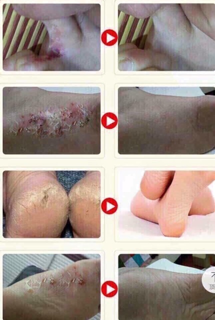 Kem ngựa trị nứt gót chân