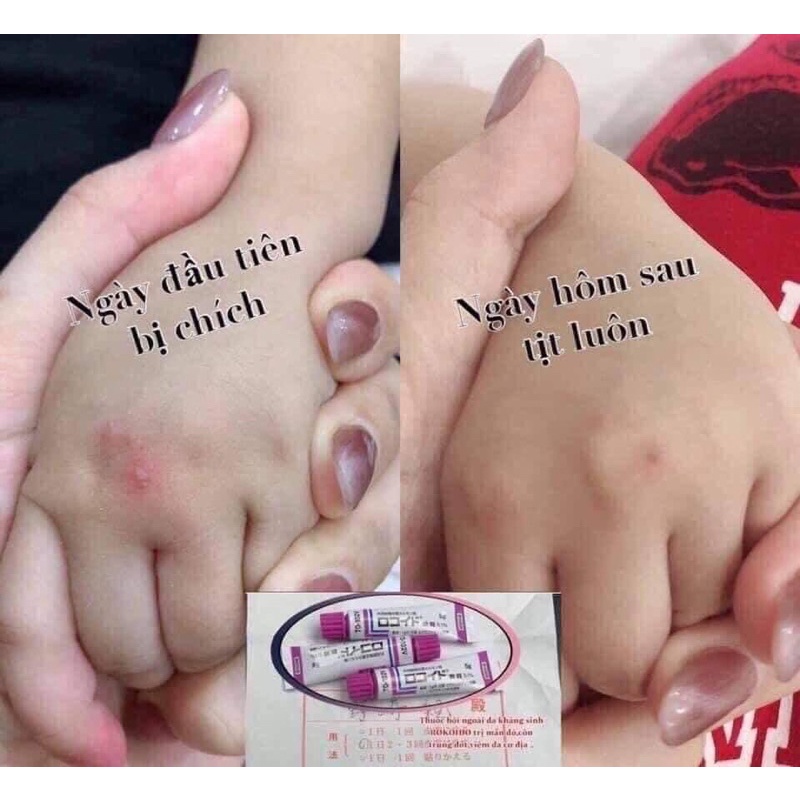 Kem Bôi Muỗi Côn Trùng Đốt Tràm Viêm Da Locoid Leo Fharma 5gr 0.1% Nhật Bản