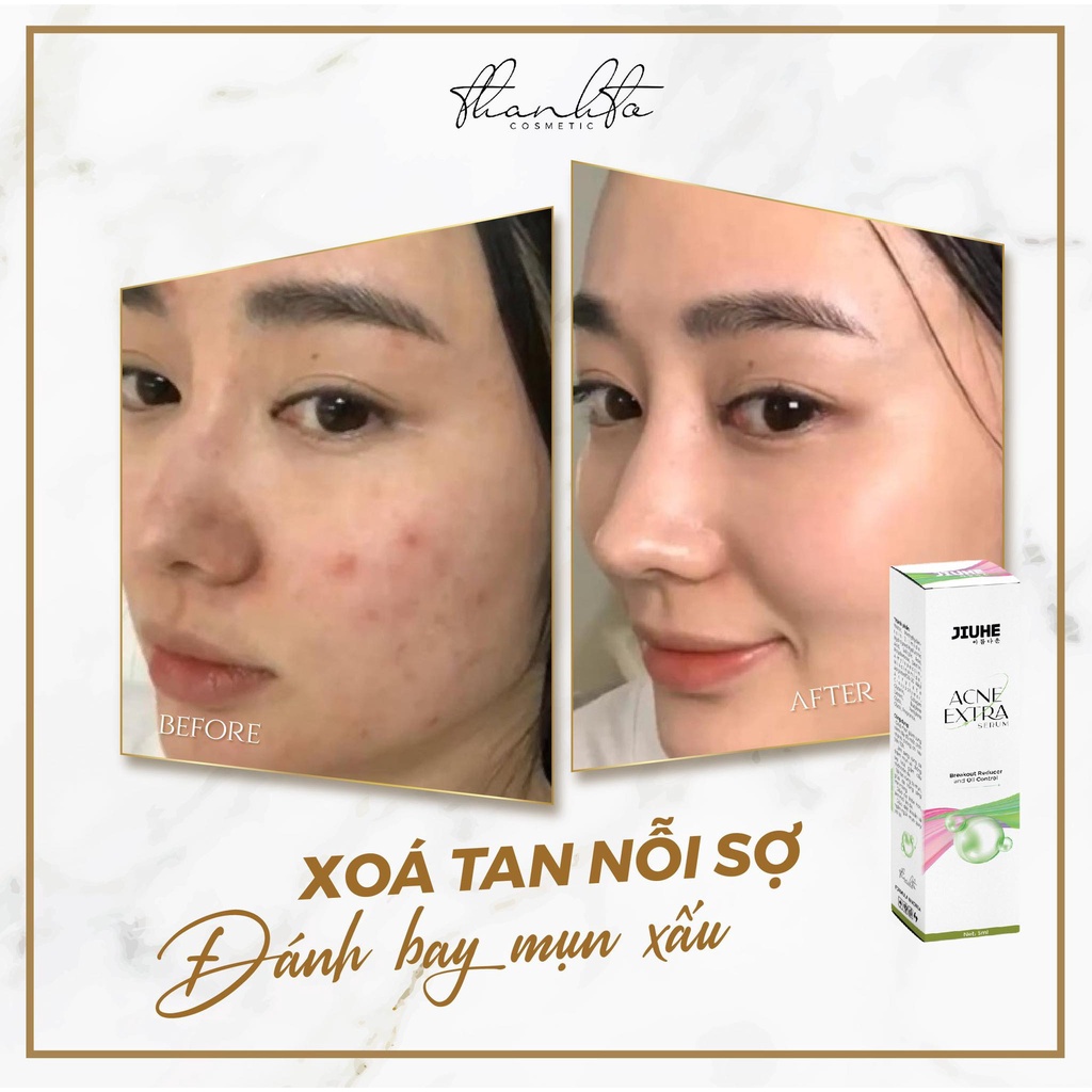 Serum Mụn Jiuhe Thanh Tô Acne Extra chính hãng Thanh Tô - Làm sáng vùng da thâm mụn và giảm dầu nhờn