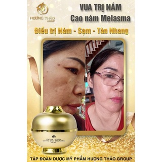 MỜ NÁM SẠM TÀN NHANG CAO NÁM MELASMA