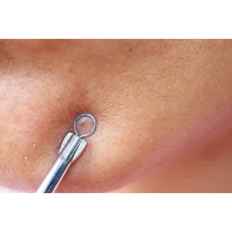 Que Nặn Mụn Đầu Đen , Trứng Cá Bằng Thép Dài 12cm
