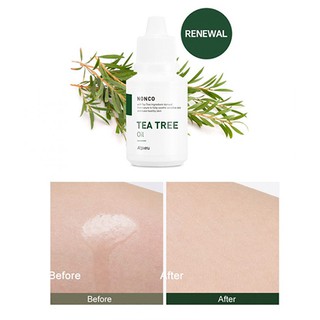 TINH DẦU TRÀM TRÀ CHẤM MỤN NONCO A'PIEU
