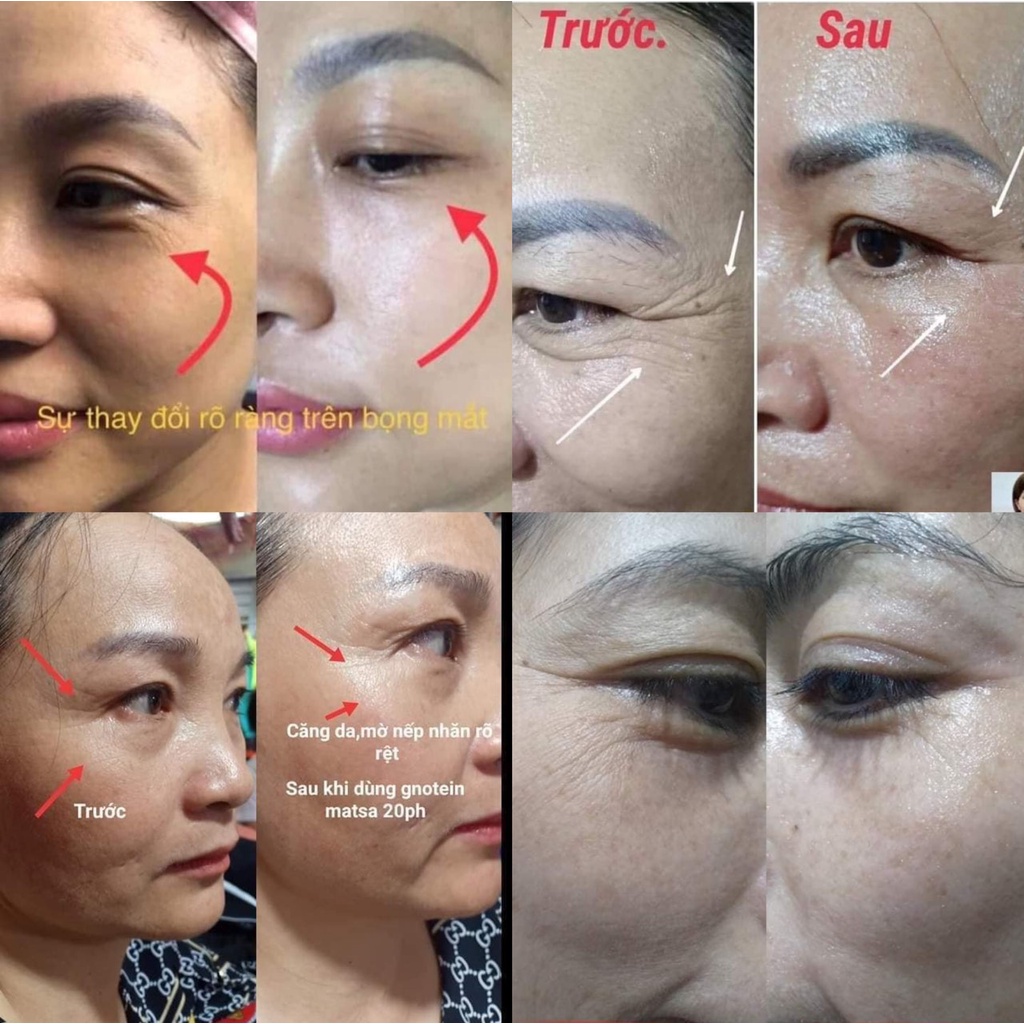 [DATE 05/22] Tinh chất vàng 24k Protein Peptide và chỉ căng cơ Protein Nano SARADOR GOLD PROTEIN PEPTIDE (Nhât)