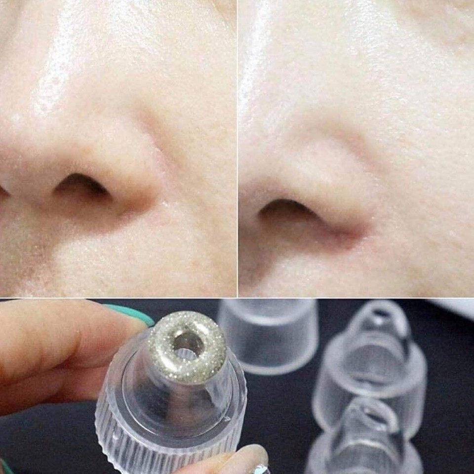 Máy hút mụn đầu đen Black Head Detection (Tặng kèm 3 đầu hút thay thế tiện lợi)