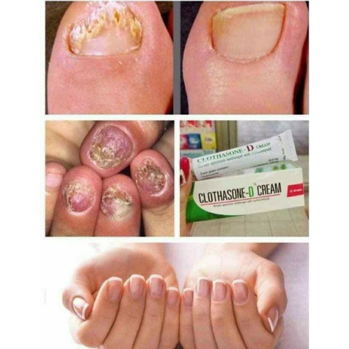 Chuẩn Thái _ Kem bôi nấm móng nấm tay chân CLOTHASONE D CREAM THÁI LAN