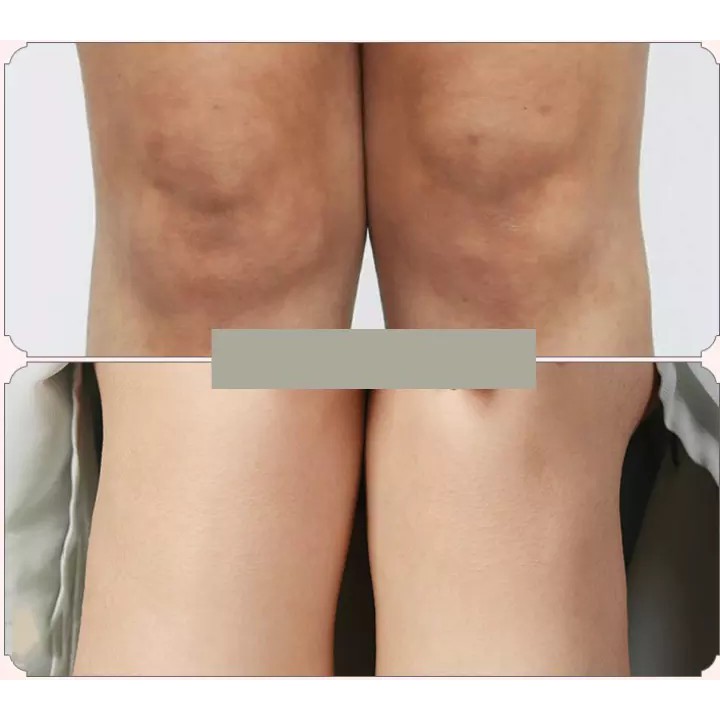 Kem giảm thâm nách,đầu gối,khỉu tay PIBAMY nội địa Trung | BigBuy360 - bigbuy360.vn