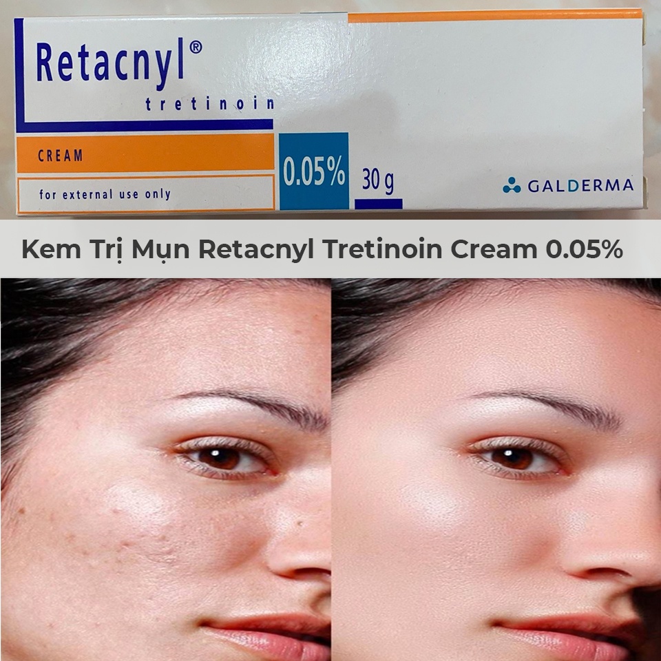 Kem giảm mụn, trẻ hóa da Tretinoin Retacnyl Cream 0.05%