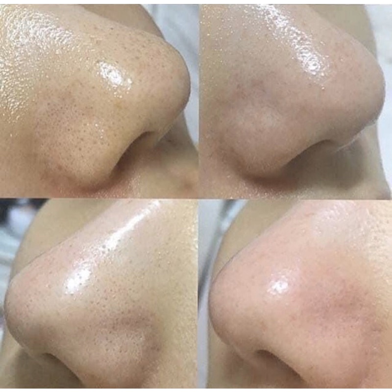 DUNG DỊCH Ủ MỤN MEDIPEEL EXTRA SUPER 9 🌱 | BigBuy360 - bigbuy360.vn