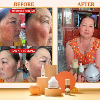 Combo Hemo Almonds dành cho da giãn mao mạch - nám máu