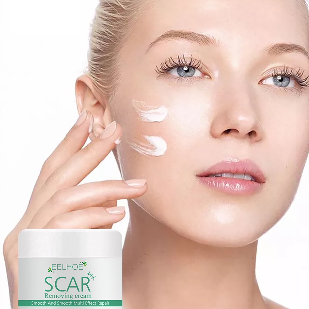 Thuốc tẩy vết sẹo cho vết sẹo cũ trên vết rạn da ở chân Kem tẩy vết sẹo mụn heby1