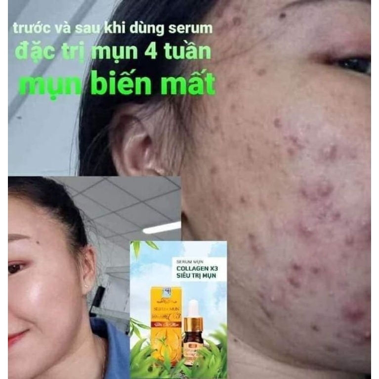 SERUM MỤN COLLEGEN X3,MP ĐÔNG ANH CHÍNH HÃNG | BigBuy360 - bigbuy360.vn
