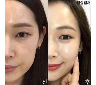 Cấy phấn Baby Mesowhite