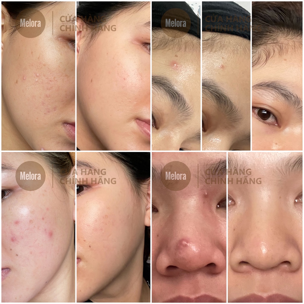 Tinh Chất Chấm Mụn Mờ Thâm Chính Hãng Cafuné Essence 15ml thành phần AHA Và Tràm Trà - Giảm Mụn, Giảm Thâm, Dưỡng Da