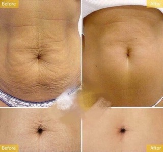 KEM TRỊ RẠN DA BỤNG OHO