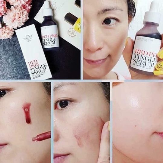 MBC Tẩy da chết hóa học RED PEEL TINGLE SERUM loại Original | BigBuy360 - bigbuy360.vn