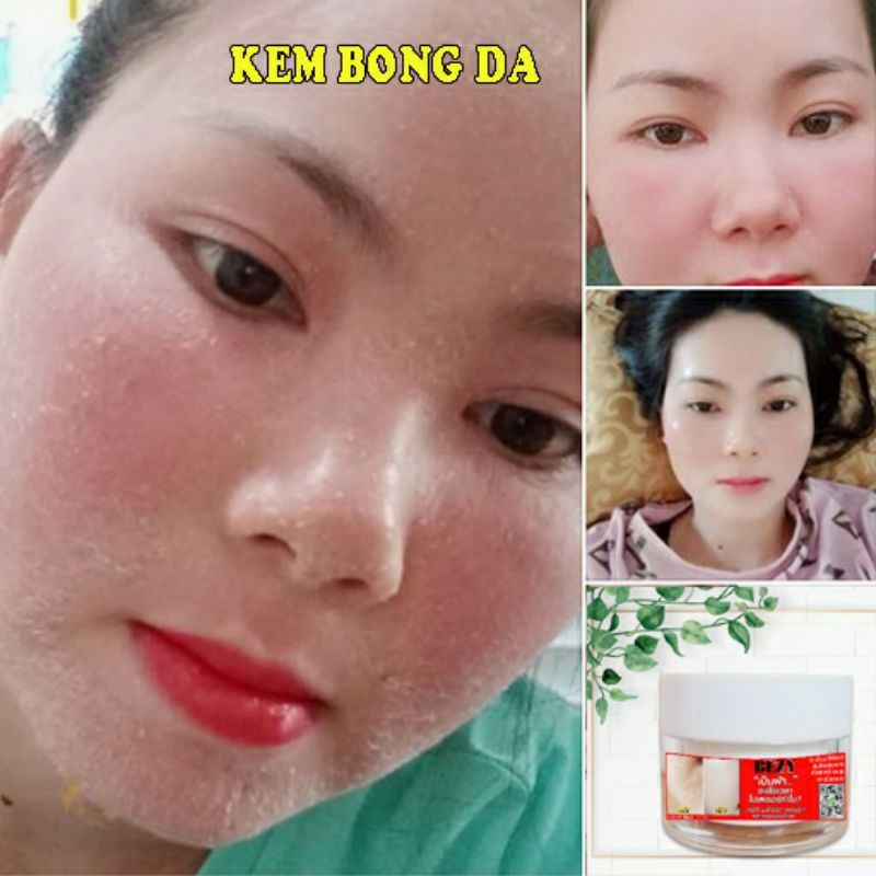 Kem Bong Da Mặt Trắng Da Mờ Thâm Nám