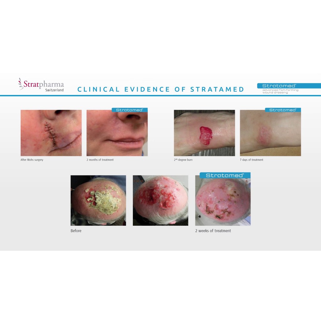 Stratamed ngừa sẹo ngay từ khi sẹo chưa hình thành cho hiệu quả vượt trội