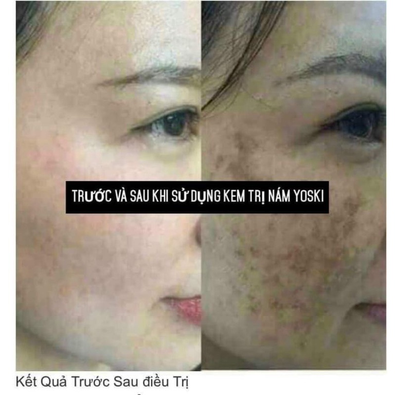 Kem nám YOSKI, mờ nám,tàn nhang,thâm sạm, tái tạo da, giúp da trắng sáng mịn màng 20gram