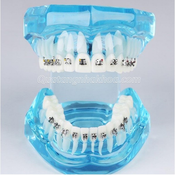 Mẫu hàm tư vấn chỉnh nha mắc cài kim loại – mô hình nắn chỉnh răng nha khoa