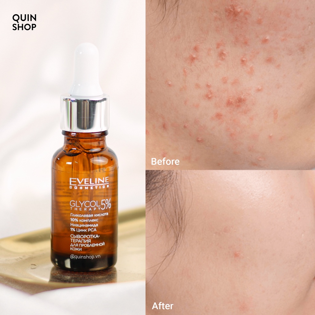 Tinh Chất Dưỡng Trắng, Giảm Mụn, Mờ Thâm Eveline Glycol Therapy 5%, Therapy 2%, Beauty & Glow Serum