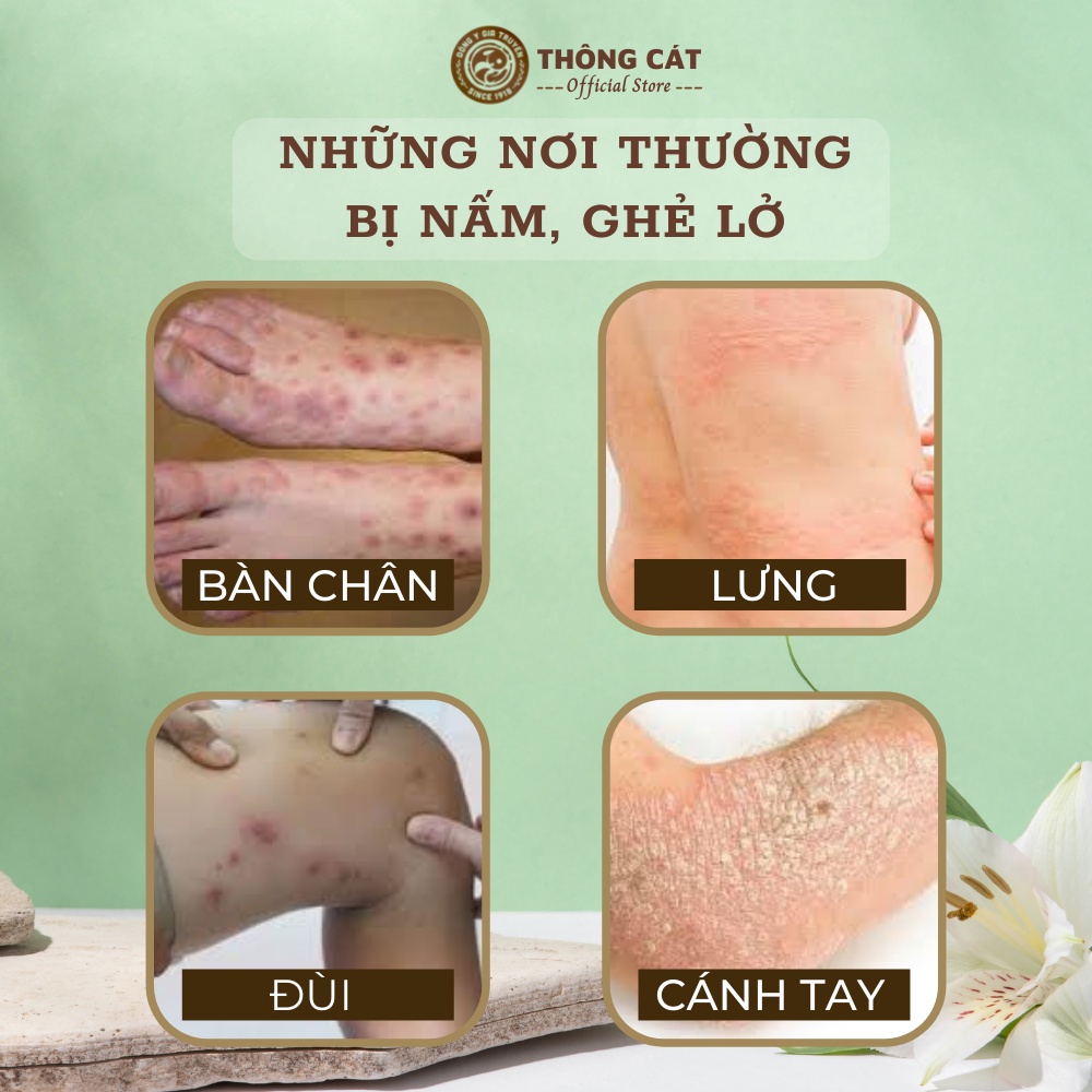 Kem bôi da liễu, kem bôi da Thông Cát HCM dứt điểm nấm da đầu, ghẻ lở, hắc lào, lang ben