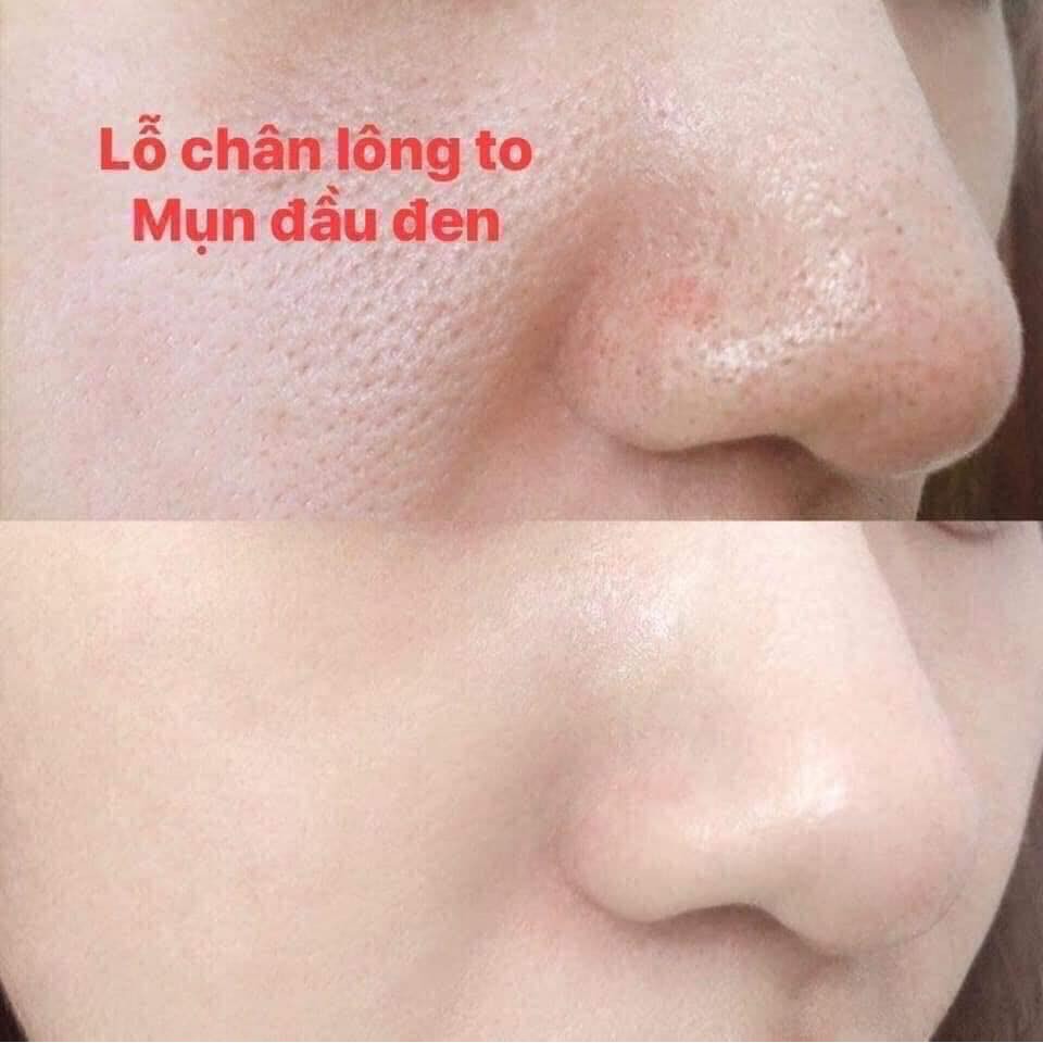 Tinh Chất SQS Siêu Se Khít Lỗ Chân Lông Nhật Bản - 15ml