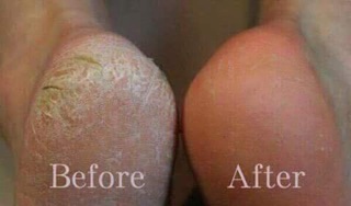 KEM BÔI NỨT GÓT CHÂN