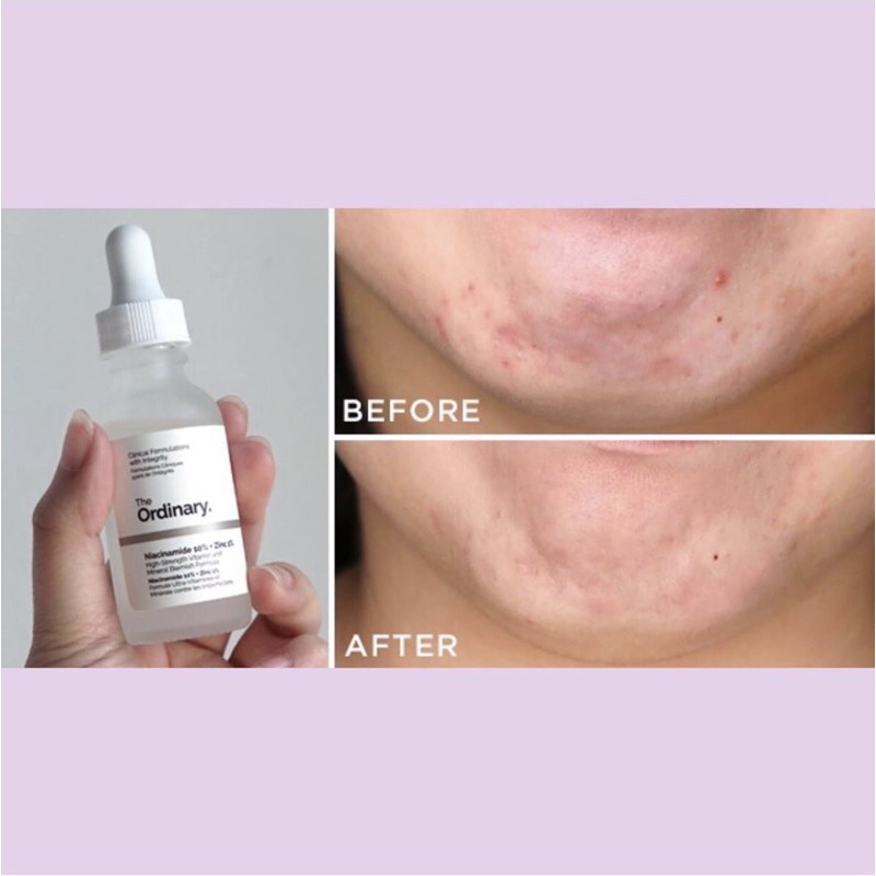 Serum The ordinary Niacinamide 10% + Zinc 1%