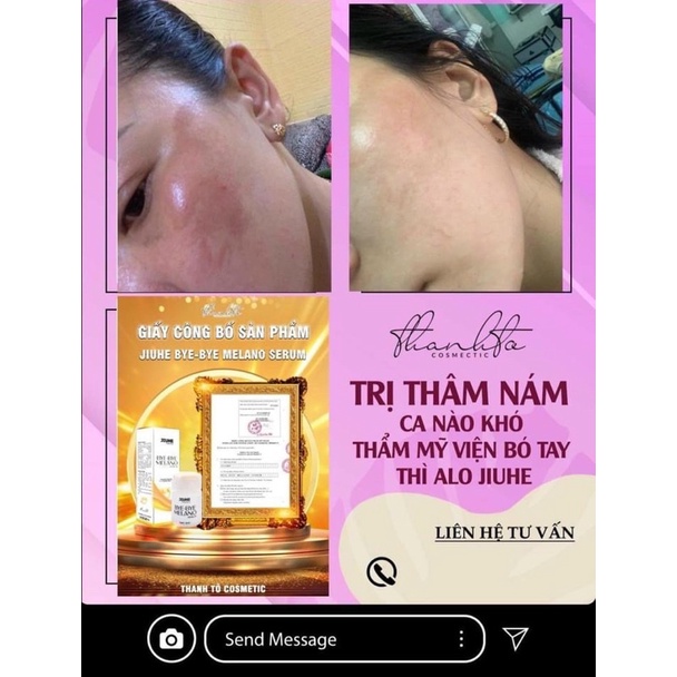 SERUM JIUHE THÂM THANH TÔ BYE BYE MELANO VER3 CHÍNH HÃNG 100%- SERUM CHUYÊN THÂM NÁM