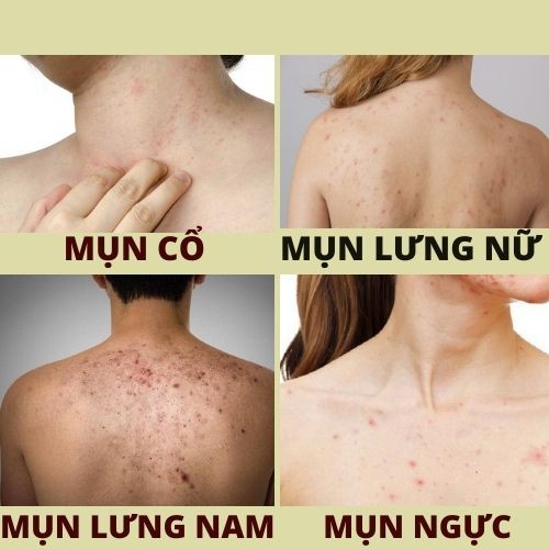 Hết mụn lưng ngực với 20 gói Thảo dược xông tắm Đông y gia truyền Thông Cát (Since 1918)