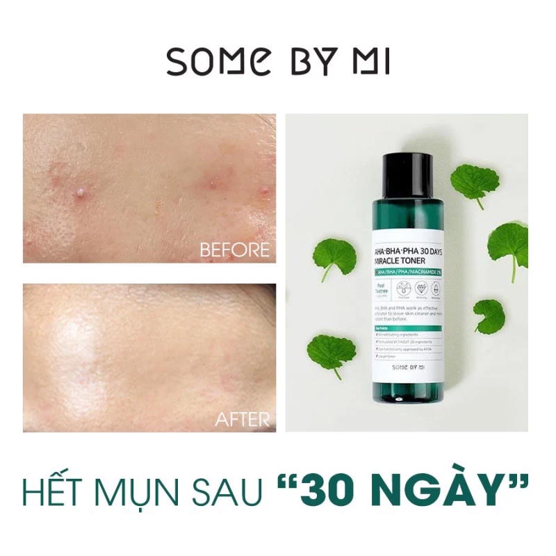 Nước hoa hồng Some By Mi AHA-BHA-PHA 30 Days Miracle Toner 150ml dành da mụn