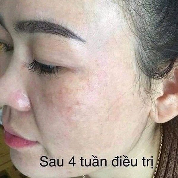 KEM NÁM HUYỀN PHI [MUA 1 TẶNG 2] (GIÁ SỈ) Tặng bông rửa chuyên dụng spa